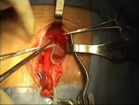 Inguinal hernia repair video