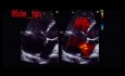 11. Echocardiography Case - What You See?