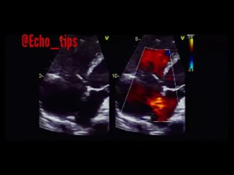 11. Echocardiography Case - What You See?