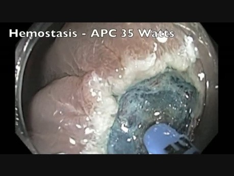 Enbloc Endoscopic Mucosal Resection Of A Large Flat Lesion in Rectum
