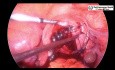 Laparoscopic myomectomy instead of hysteroscopic myomectomy for large submucous fibroid