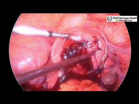 Laparoscopic myomectomy instead of hysteroscopic myomectomy for large submucous fibroid