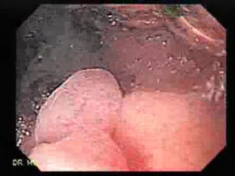 Familial Adenomatous Polyposis of the Colon (27 of 29)