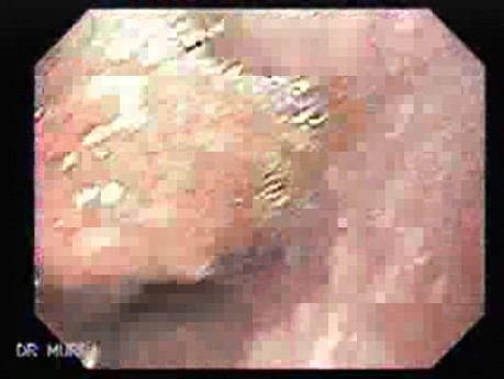 Distal Esophageal Squamous Cell Carcinoma - Esophagoscopy