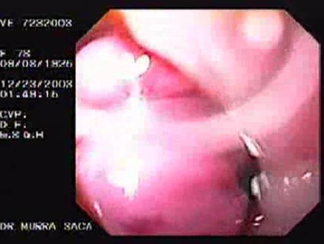 Hemorrhage Due Status Post Rubber Band Ligation of Esophageal Varices - Three Ligated Varices