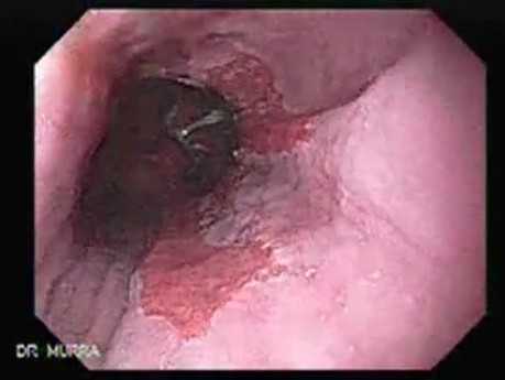 Barrett's Esophagus of long segment (1 of 11)