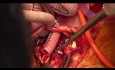 Total Aortic Arch Replacement with Stented Elephant Trunk 