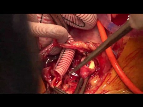 Total Aortic Arch Replacement with Stented Elephant Trunk 