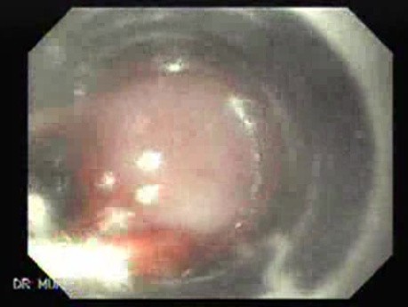 Ligation of Esophageal Varices -  Application of Rubber Bands