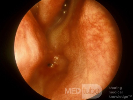 Choanal Atresia