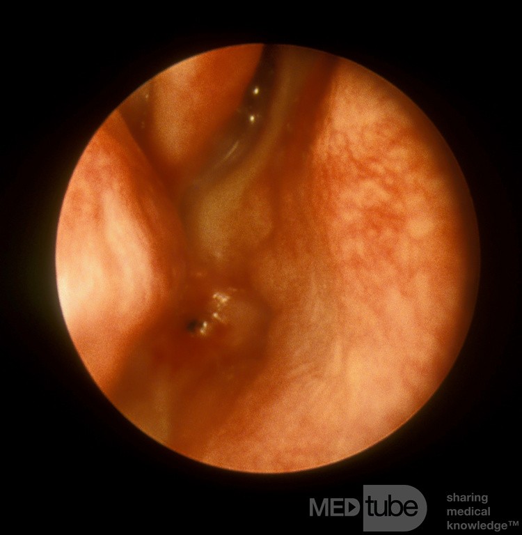 Choanal Atresia