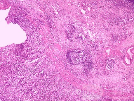 Diffuse Adenocarcinoma with signet ring cells (17 of 18)