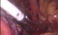 Laparoscopic Pelvic Lymph Node Dissection