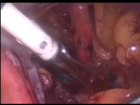 Laparoscopic Pelvic Lymph Node Dissection