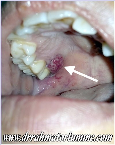 Pyogenic Granuloma Gravidarum of The Gingiva