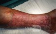 Atrophic Lower Leg Ulceration - Stage III