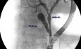 Choledocolithiasis (ERCP)