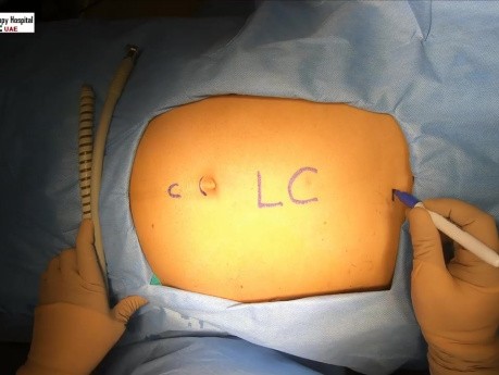 Skin to Skin Laparoscopic Cholecystectomy in 4K