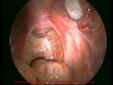 Laparoscopy video