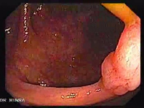 Sessile Tubulovillous Adenoma (2 of 11)