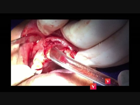 Crown Length Surgery