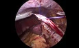 Laparoscopic Latero-lateral Ureteropyeloplasty