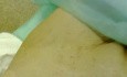 The Examination Of Femoral Hernia