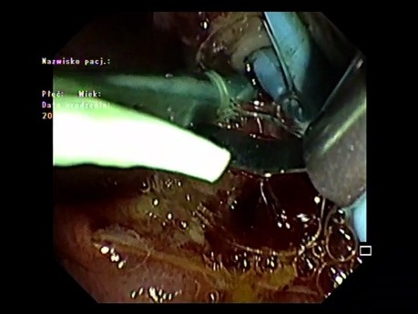 Ampullectomy (part 3)