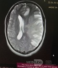 Decompressive Craniotomy