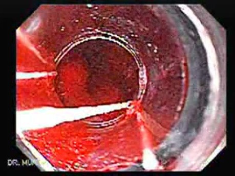 Esophageal Varix - Banding of Two Bleeding Varices