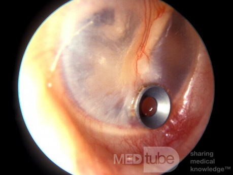 Stainless Steel Ear Ventilation Tube