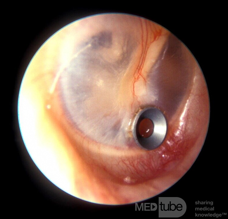 Stainless Steel Ear Ventilation Tube