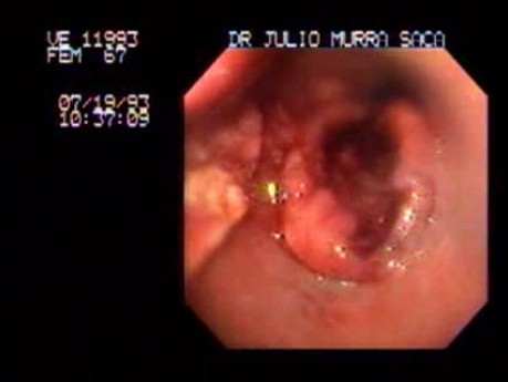 Esophageal Squamous Cell Carcinoma - 67 Year-Old Female With Progressive Dysphagia