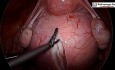 Laparoscopic Removal of Posterior Cervical Fibroid