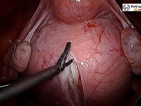 Laparoscopic Removal of Posterior Cervical Fibroid