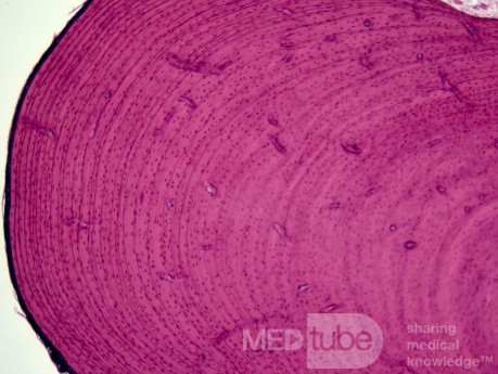 Histology of Exostosis