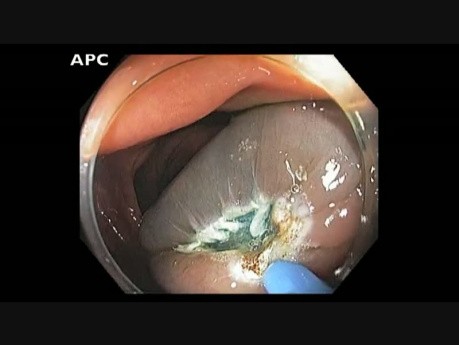 Ascending Colon - Flat Lesion Tethered by Prior Jumbo Biopsy - EMR
