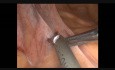 Laparoscopic Rectopexy