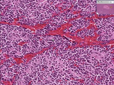 Adrenal - Neuroblastoma