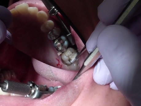 Prevent Rmgi From Sticking To Your Instruments