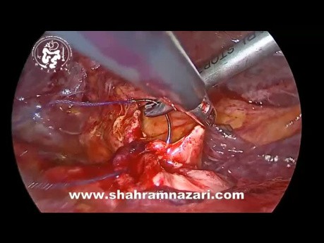 Choledochoduodenostomy After Failed ERCP