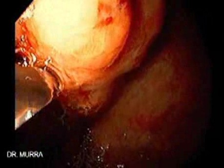 Gastric Varices (17 of 25)
