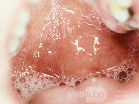 Peritonsillar Abscess