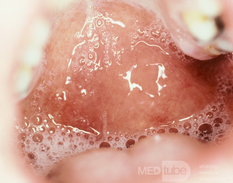 Peritonsillar Abscess