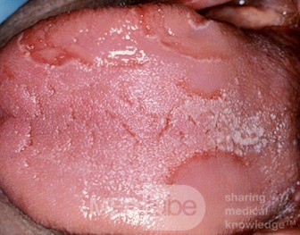 Geographic Tongue