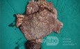Mixed Mullerian Tumour Of The Uterus, 3