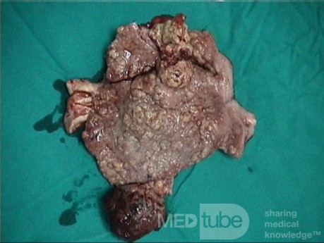 Mixed Mullerian Tumour Of The Uterus, 3