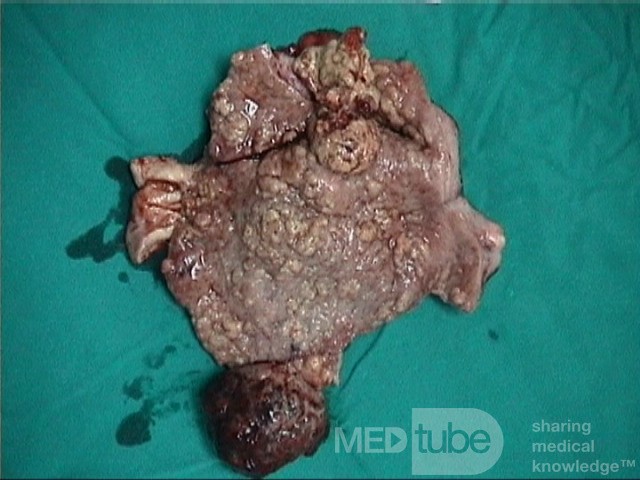 Mixed Mullerian Tumour Of The Uterus, 3