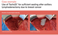 Use of TachoSil® for Sufficient Sealing After Axillary Lymphadenectomy Due to Breast Cancer