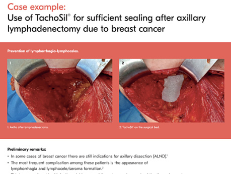 Use of TachoSil® for Sufficient Sealing After Axillary Lymphadenectomy Due to Breast Cancer
